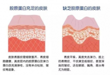 注射膠原蛋白真的能改善臉部皺紋?