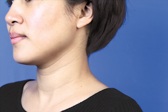 消除頸紋的按摩手法 一學就會 消除頸紋的按摩手法 一學就會