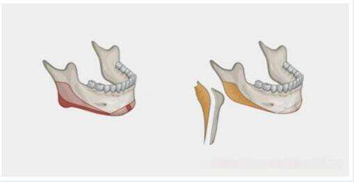 削骨瘦臉 術(shù)后3件事一定要做好