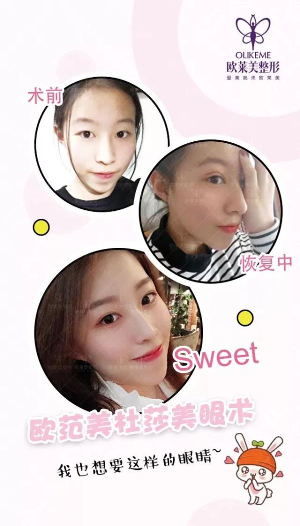 義烏割雙眼皮價格?歐萊美免費做雙眼皮招募中! 義烏割雙眼皮價格?歐萊美免費做雙眼皮招募中!