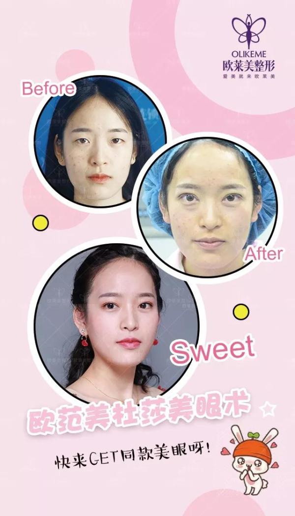 義烏割雙眼皮價格?歐萊美免費做雙眼皮招募中! 義烏割雙眼皮價格?歐萊美免費做雙眼皮招募中!