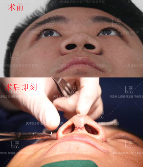 關于『 萌芽仿生綜合隆鼻術』你想知道的都在這里！