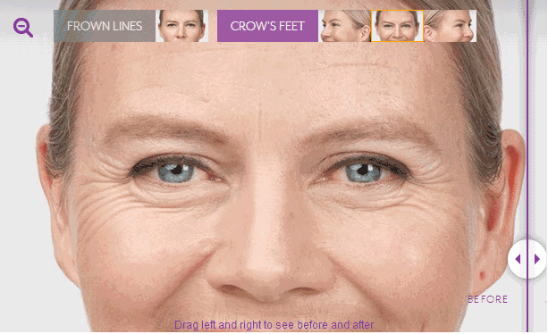 義烏除皺多少錢?歐萊美10000支除皺針免費送!!-易網健康養生網 義烏除皺多少錢?歐萊美10000支除皺針免費送!!