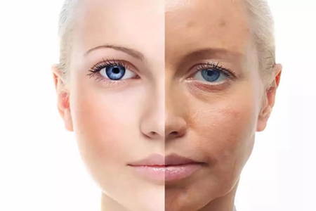 痘痘肌膚、干皮、油皮膚質大不同，護膚方法有訣竅