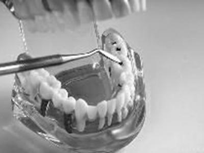 牙齒漂白前先治牙病