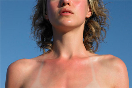 肌膚曬傷之后的幾個(gè)有效修復(fù)方法，不要輕視這個(gè)問題