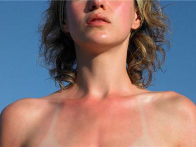 肌膚曬傷之后的幾個有效修復方法,不要輕視這個問題