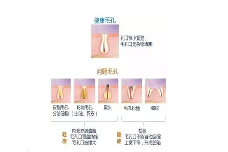 毛孔粗大如何清潔 改善膚質必備的幾個護膚小知識