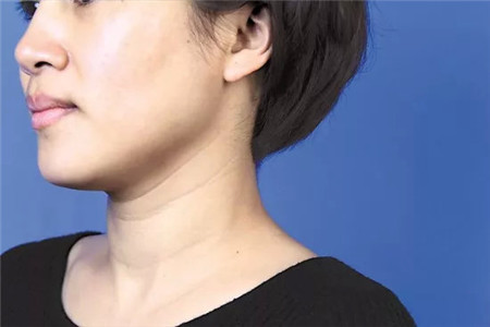 魚尾紋形成的原因是什么?怎樣才能有效去除-易網健康<a href=http://www.jsjjzhkt.cn/jkys/ target=_blank class=infotextkey>養生</a>網 魚尾紋形成的原因是什么?怎樣才能有效去除