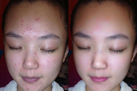 女性長膿包型痤瘡怎么治理，紅腫膿皰護理不當容易留痘疤