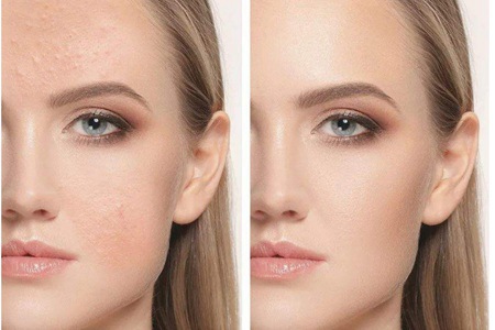 女性長膿包型痤瘡怎么治理，紅腫膿皰護理不當容易留痘疤