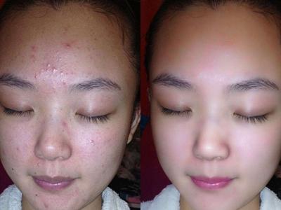 女性長膿包型痤瘡怎么治理,紅腫膿皰護理不當容易留痘疤