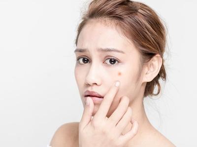 面部痤瘡如何治療,女性針對不同膚質進行治療最佳方法