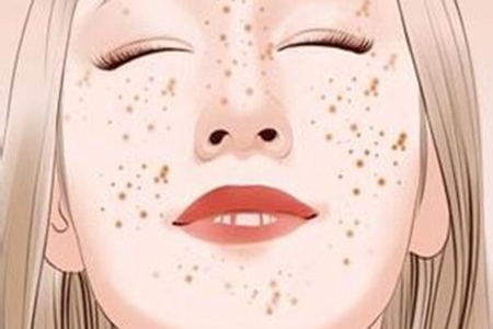 女性激光祛斑會反彈嗎,醫美后五個注意事項-易網健康養生網 女性激光祛斑會反彈嗎,醫美后五個注意事項