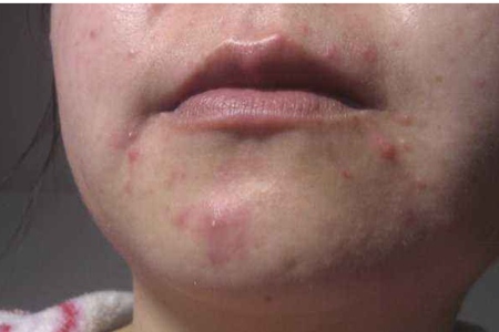 女性下巴長痘,原來是身體這里出問題,教你五招去除痘痘-易網<a href=http://www.jsjjzhkt.cn/ target=_blank class=infotextkey>健康養生</a>網 女性下巴長痘,原來是身體這里出問題,教你五招去除痘痘