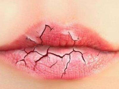 嘴唇干燥脫皮怎么辦? 教你5招輕松應對