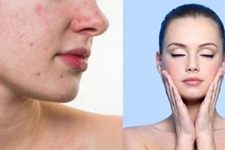 閉口是什么,它會慢慢自己消失嗎,去除閉口要靠這四招-易網健康<a href=http://www.jsjjzhkt.cn/jkys/ target=_blank class=infotextkey>養生</a>網 閉口是什么,它會慢慢自己消失嗎,去除閉口要靠這四招