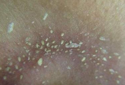 鼻子上擠出來的白色東西是什么？如何正確去除