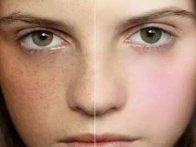 為什么皮膚白的容易長斑?長斑該如何護理?