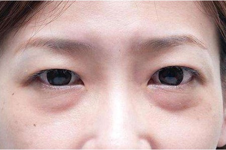 眼袋的形成原因,女性去眼袋最有效的土方法-易網健康<a href=http://www.jsjjzhkt.cn/jkys/ target=_blank class=infotextkey>養生</a>網 眼袋的形成原因,女性去眼袋最有效的土方法