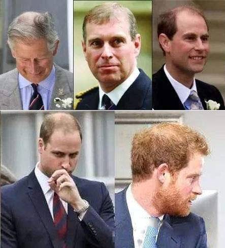 沒有家族脫發史 我為什么年紀輕輕也禿了