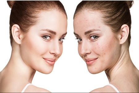 女生30歲臉上長痘痘的原因,長痘痘效果最佳的治療方法-易網(wǎng)<a href=http://www.jsjjzhkt.cn/ target=_blank class=infotextkey>健康養(yǎng)生</a>網(wǎng) 女生30歲臉上長痘痘的原因,長痘痘效果最佳的治療方法