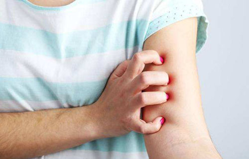 冬季濕疹反復發作怎么辦? 做到這6點遠離濕疹