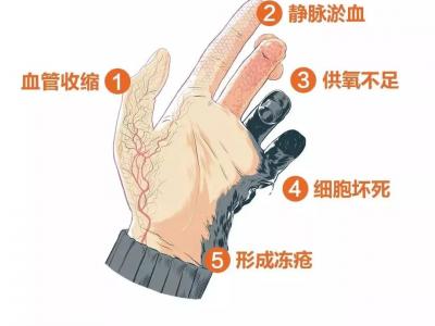 冬天天氣冷長(zhǎng)凍瘡怎么辦？6個(gè)小妙招教給你