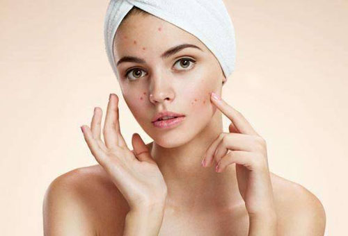 面部頻繁起痘是怎么回事？這4個(gè)原因要注意