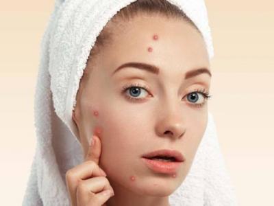 臉上的痘坑能去除嗎 簡單9招讓你擺脫“月球臉”