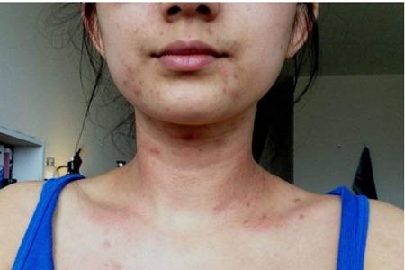 女生下巴長痘的原因，教你六個訣竅簡單祛痘