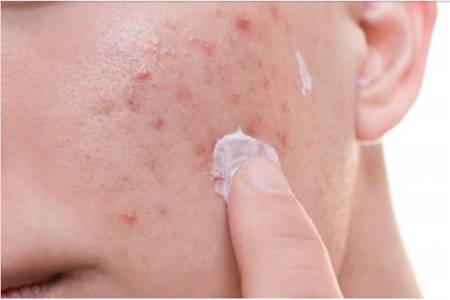 引起額頭長痘的原因，女生做這四件事快速祛痘