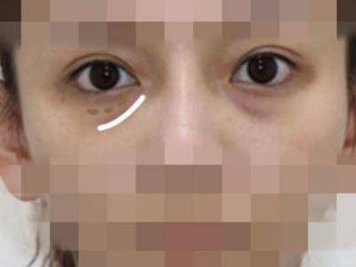 怎樣祛眼袋，讓眼袋消失無蹤的有效妙招