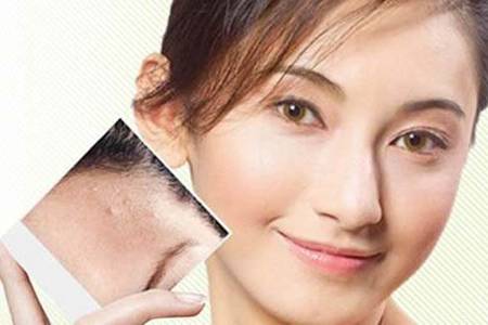 祛痘印最好的六個方法，女生淡化痘印效果看得見