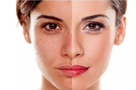 光子嫩膚的危害缺陷，醫美光子嫩膚術后的注意事項