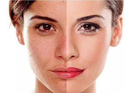 光子嫩膚的危害缺陷，醫(yī)美光子嫩膚術(shù)后的注意事項(xiàng)