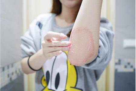 雞皮膚治療多少錢，最省錢最好的雞皮治療方法