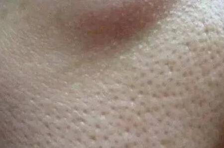 毛孔粗大怎么辦 針對不同情況的毛孔粗大該如何護膚？