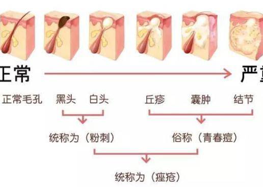 臉上長(zhǎng)痘痘怎么調(diào)理?做好這三點(diǎn)讓痘痘遠(yuǎn)離你-易網(wǎng)健康<a href=http://www.jsjjzhkt.cn/jkys/ target=_blank class=infotextkey>養(yǎng)生</a>網(wǎng) 臉上長(zhǎng)痘痘怎么調(diào)理?做好這三點(diǎn)讓痘痘遠(yuǎn)離你