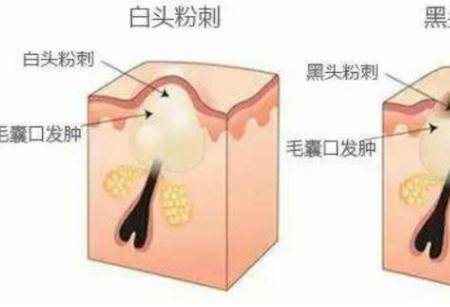 油性皮膚會(huì)有哪些肌膚問題 如何改善油性皮膚問題