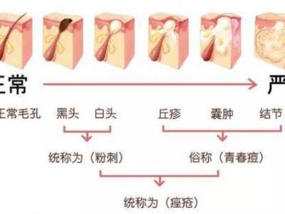 臉上長痘痘怎么調理?做好這三點讓痘痘遠離你