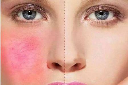 臉過敏發紅癢怎么辦,春季防過敏教你六個方法-易網<a href=http://www.jsjjzhkt.cn/ target=_blank class=infotextkey>健康養生</a>網 臉過敏發紅癢怎么辦,春季防過敏教你六個方法