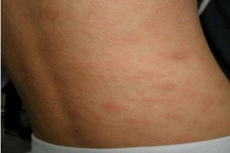 玫瑰糠疹皮膚病怎么引起的,治療方法中忌口這五種食物-易網健康<a href=http://www.jsjjzhkt.cn/jkys/ target=_blank class=infotextkey>養生</a>網 玫瑰糠疹皮膚病怎么引起的,治療方法中忌口這五種食物