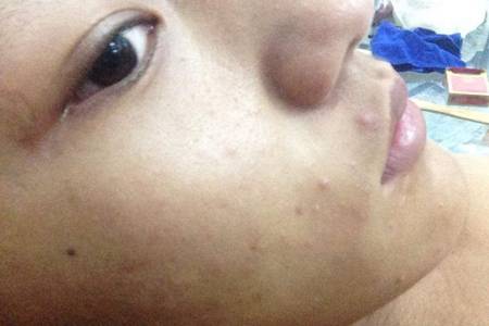 皮膚過敏癥狀有哪些,女性皮膚初期過敏如何治療-易網健康養生網 皮膚過敏癥狀有哪些,女性皮膚初期過敏如何治療