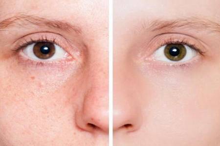 閉口粉刺是什么怎么去除  5招讓你輕松去除閉口痘痘