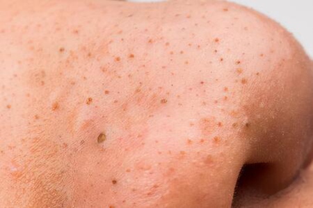 怎么去黑頭？這五個方法幫助你消滅它們