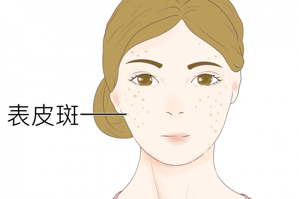 怎樣祛斑快效果好