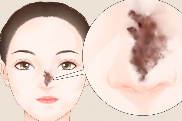 隆鼻可以只隆鼻梁不隆鼻尖嗎-易網(wǎng)<a href=http://www.jsjjzhkt.cn/ target=_blank class=infotextkey>健康養(yǎng)生</a>網(wǎng) 隆鼻可以只隆鼻梁不隆鼻尖嗎