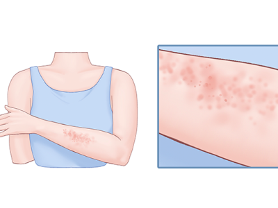 化妝品過敏的癥狀是什么?