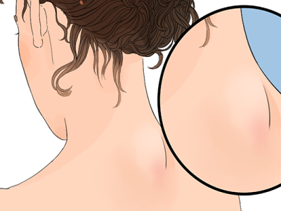 脖子上有頸紋怎么去掉